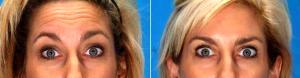 Dr. Gregory Pippin, MD, Metairie Facial Plastic Surgeon - Botox For Forehead Wrinkles