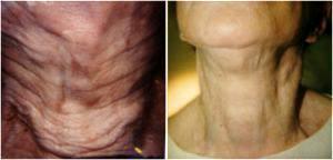 Dr. Howard Sobel, Dermatologist In New York City, New York - Botox Injections Before And After