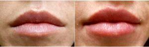 Dr. Jeff Angobaldo, MD, Dallas Plastic Surgeon - 20 Year Old Woman Treated With Restylane