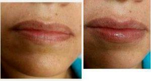 Dr. Jeff Angobaldo, MD, Dallas Plastic Surgeon - 39 Year Old Woman Treated With Restylane