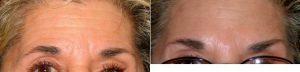 Dr. Jeffrey E. Schreiber, MD, FACS, Baltimore Plastic Surgeon - Botox Treatment For Forehead And Brow Wrinkles