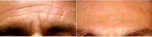Dr. Jeffrey Goldstein, DO, New York Physician - 38 Year Old Man Treated With Botox