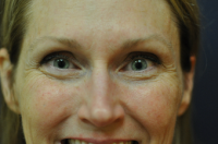 Dr. Jennifer Reichel, MD, Seattle Dermatologist - Botox Between Eyebrows