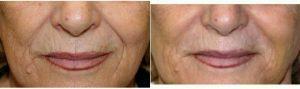 Dr. John Layke, DO, FACS, Beverly Hills Plastic Surgeon - 67 Year Old Woman Treated With Juvederm