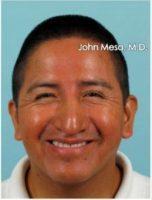 Dr. John Mesa, MD, New York Plastic Surgeon - 31 Year Old Latin Man Treated With Botox For Crow's Feet Wrinkles