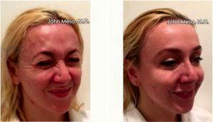 Dr. John Mesa, MD, New York Plastic Surgeon - 44 Year Old Woman Treated With Botox Crow's Feet Wrinkles