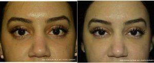 Dr. Jose Rodríguez-Feliz, MD, Miami Plastic Surgeon - 28 Year Old Woman With Hollow Eyes