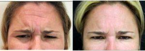 Dr. Joshua Lampert, MD,FACS, Miami Plastic Surgeon - 37 Year Old Woman Treated With Botox