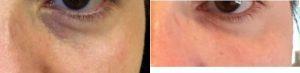 Dr. Kaleroy Papantoniou, MD, FAAD, Great Neck Dermatologic Surgeon - 36 Year Old Woman Treated With Restylane