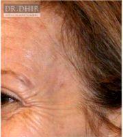 Dr. Karan Dhir, MD, Beverly Hills Facial Plastic Surgeon - 26 Year Old Woman Treated With Botox