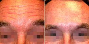 Dr. Karen Beasley, MD, Baltimore Dermatologic Surgeon - 46 Year Old Man Treated With Botox For Forehead Wrinkles