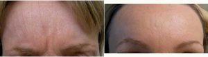 Dr. Kathleen L. Behr, MD, Fresno Dermatologist - 44 Year Old Woman Treated With Botox