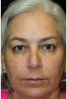 Dr. Kris M. Reddy, MD, FACS, West Palm Beach Plastic Surgeon - 50 Year Old Woman Treated With Botox For Forehead