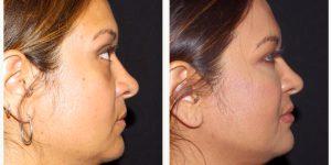 Dr. Landon Pryor, MD, FACS, Rockford Plastic Surgeon - 43 Year Old Woman Treated With Restylane To Lips