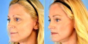 Dr. Landon Pryor, MD, FACS, Rockford Plastic Surgeon - 49 Year Old Woman Treated With ArteFill