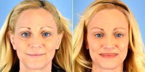 Dr. Landon Pryor, MD, FACS, Rockford Plastic Surgeon - 54 Year Old Woman Treated With ArteFill