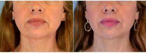 Dr. Landon Pryor, MD, FACS, Rockford Plastic Surgeon - 55 Year Old Woman Treated With ArteFill