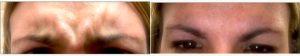 Dr. Leslie Kim, MD, MPH, Columbus Facial Plastic Surgeon - 28 Year Old Woman Treated With Botox 11 Lines