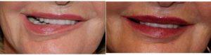 Dr. Leslie Kim, MD, MPH, Columbus Facial Plastic Surgeon - 65 Year Old Woman Treated With Botox And Restylane Filler