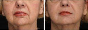 Dr. Leyda Elizabeth Bowes, MD, Miami Dermatologic Surgeon - Correction Of Nasolabial Folds And Marionette Lines With Restylane And Perlane