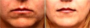 Dr. Leyda Elizabeth Bowes, MD, Miami Dermatologic Surgeon - Restylane Before & After