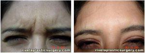 Dr. Lucian Rivela, Plastic Surgeon In The Woodlands, TX - Botox Injections In Glabella