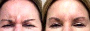 Dr. Marguerite A. Germain, MD, Charleston Dermatologic Surgeon - 36 Year Old Woman Treated With Botox Between The Eyes