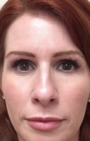 Dr. Marguerite A. Germain, MD, Charleston Dermatologic Surgeon - 39 Year Old Woman Treated With Botox
