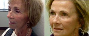 Dr. Meg Cherry, MD, Birmingham Dermatologic Surgeon - Sculptra For Volume Loss, 6 Months After 4 Vials In 65 Year Old Female
