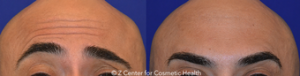 Dr. Michael A. Zadeh, MD, FACS, Sherman Oaks General Surgeon - Botox For Forehead Lines