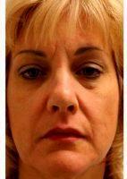 Dr. Michael H. Swann, MD, Springfield Dermatologic Surgeon - 40 Year Old Woman Treated With Botox And Juvederm