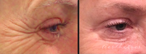 Dr. Michael Tantillo, Boston Plastic Surgeon - Crows Feet Botox Before And After
