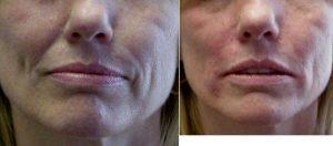 Dr. Neal Goldberg, MD, Westchester Plastic Surgeon - 42 Year Old Lady With Juvederm To Face
