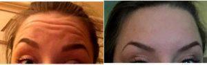 Dr. Neil Tanna, MD, FACS, New York Plastic Surgeon - 34 Year Old Woman Treated With Botox