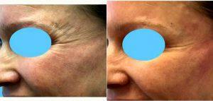 Dr. Nelson Castillo, MD, Atlanta Plastic Surgeon - 47 Year Old Woman Treated With Botox