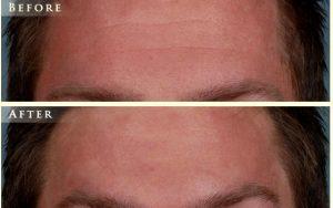 Dr. Nick Slenkovich, MD, Littleton CO Plastic Surgeon - Botox Before And After (1)