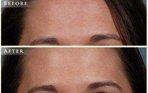 Dr. Nick Slenkovich, MD, Littleton CO Plastic Surgeon - Botox Before And After (2)
