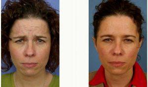 Dr. Nicolette Picerno, MD, Denver Facial Plastic Surgeon - 46 Year Old Woman Treated With Botox