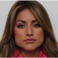 Dr. Nima Shemirani, MD, Beverly Hills Facial Plastic Surgeon - 29 Year Old Woman Treated With Botox Under Eyes