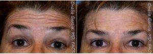 Dr. Onelio Garcia Jr, MD, FACS, Miami Plastic Surgeon - 38 Year Old Woman Treated With Botox