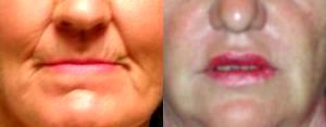 Dr. Perlman, Plastic Surgeon In Houston, TX - Restylane Before And After