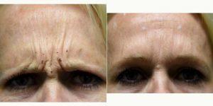 Dr. Peter N. Butler, MD, Pensacola Plastic Surgeon - 49 Year Old Woman Treated With Botox