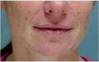 Dr. Peter T. Truong, MD, Fresno Oculoplastic Surgeon - 46 Year Old Woman Treated With Botox In Masseter Muscle.