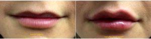 Dr. Ramandeep Sidhu, MD, Issaquah Vascular Surgeon - 28 Year Old Woman Treated With Juvederm