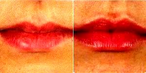 Dr. Rita Rakus, MBBS, London Physician - 39 Year Old Woman Treated With Juvederm Before & After