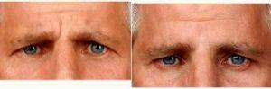 Dr. Robert W. Sheffield, MD, Santa Barbara Plastic Surgeon - 63 Year Old Man Treated With Botox For Forehead Wrinkles