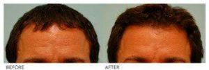 Dr. Sam Lam, MD, FACS, Dallas Facial Plastic Surgeon - Male Botox