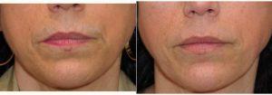 Dr. Satyen Undavia, MD, Philadelphia Facial Plastic Surgeon - 49 Year Old Woman Treated With Restylane