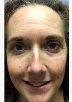 Dr. Satyen Undavia, MD, Philadelphia Facial Plastic Surgeon - 50 Year Old Woman Treated With Botox