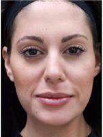 Dr. Shaun Patel, MD, Miami Physician - 27 Year Old Female Treated With Botox For Forehead Lines, Frown Lines, And Crow's Feet
